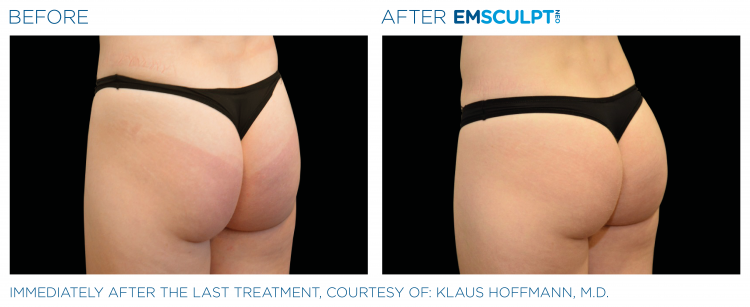 EMSCULPT NEO Before & After Treatment | Body Sculpting | Sculpt Your Vision