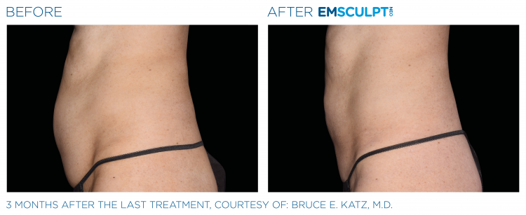 EMSCULPT NEO Before & After Treatment | Body Sculpting | Sculpt Your Vision