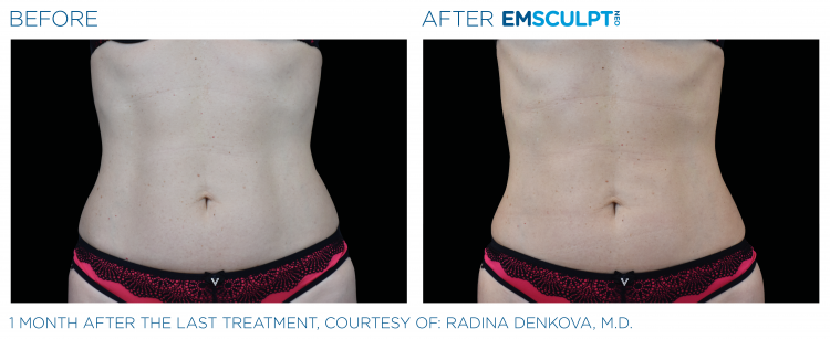 EMSCULPT NEO Before & After Treatment | Body Sculpting | Sculpt Your Vision