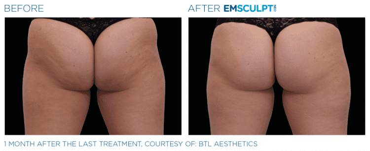 EMSCULPT NEO Before & After Treatment | Body Sculpting | Sculpt Your Vision