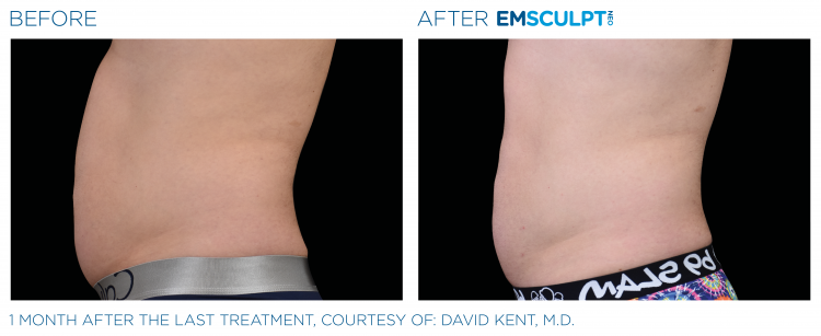 EMSCULPT NEO Before & After Treatment | Body Sculpting | Sculpt Your Vision