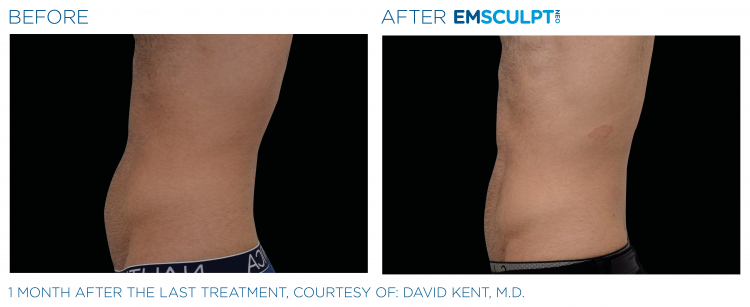 EMSCULPT NEO Before & After Treatment | Body Sculpting | Sculpt Your Vision